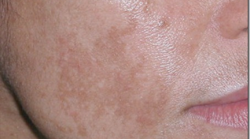 Các phương pháp điều trị laser cho nám da